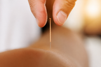 Acupuncture Service